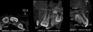 achados em tomografia cone beam