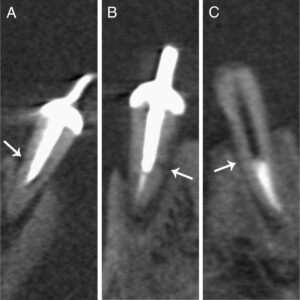 fratura radicular em tomografia cone beam