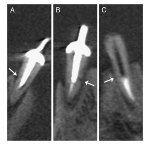 fratua radicular em tomografia cone beam