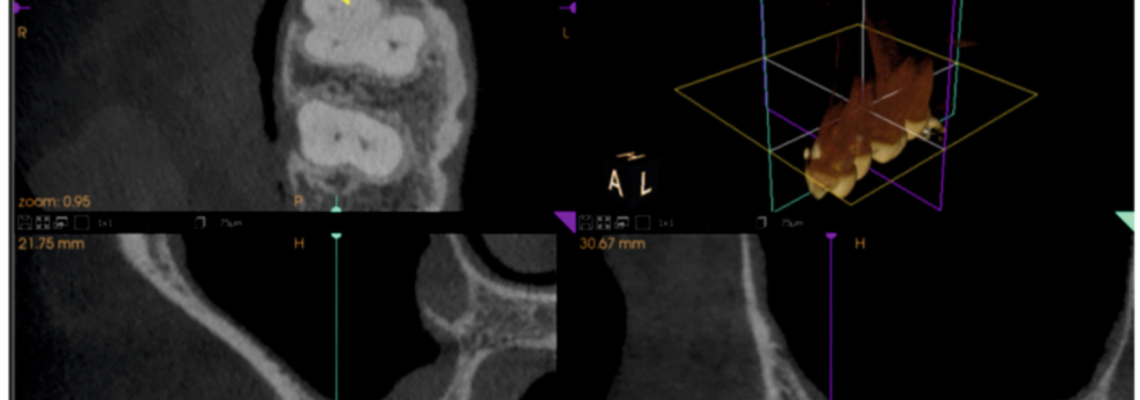 Tomografia Cone Beam na análise tridimensional do segundo canal mesiovestibular