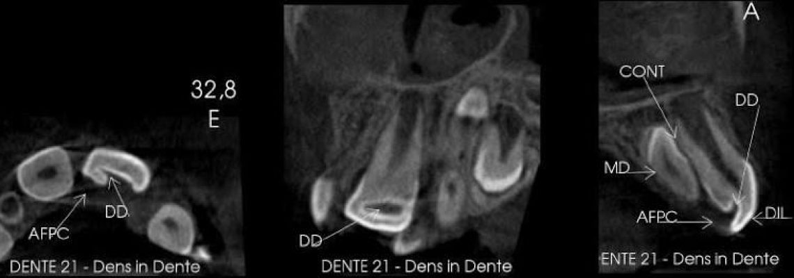 achados em tomografia cone beam