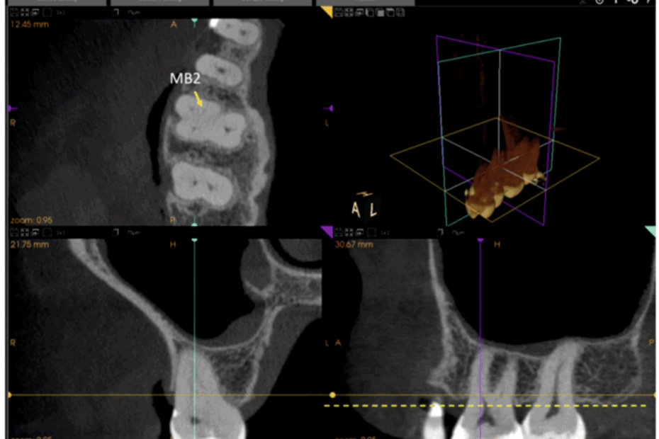Tomografia Cone Beam na análise tridimensional do segundo canal mesiovestibular
