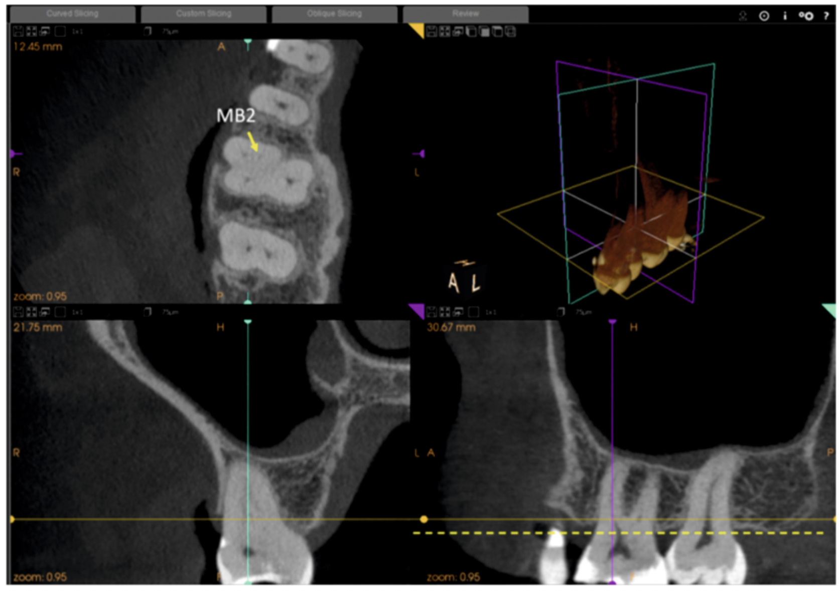 Tomografia Cone Beam na análise tridimensional do segundo canal mesiovestibular