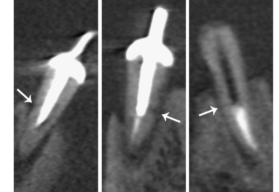 fratua radicular em tomografia cone beam